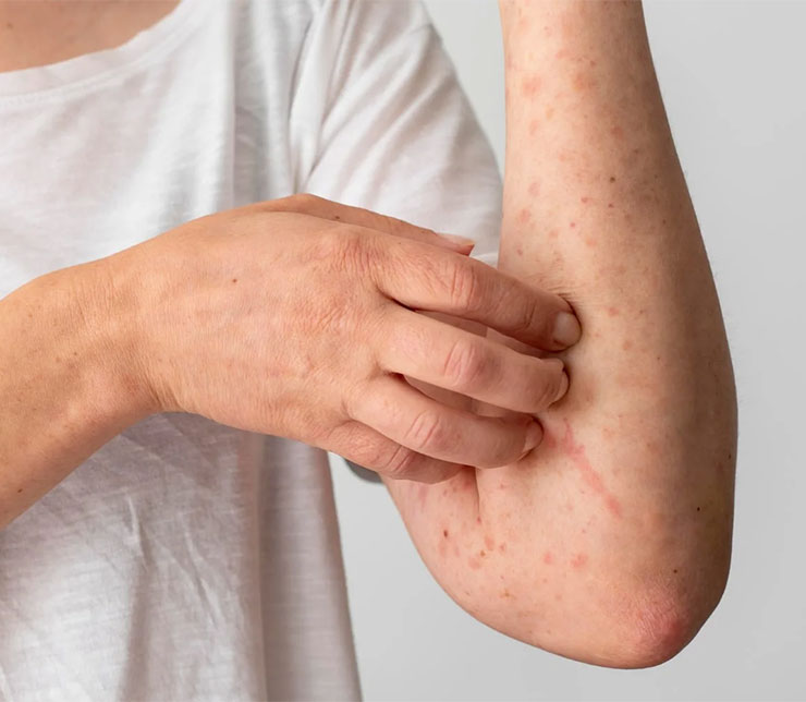 Anti-Allergic Medicines